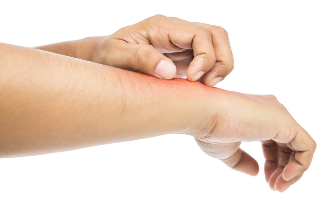 Understanding Excoriation Disorder: Symptoms, Causes, and Treatment