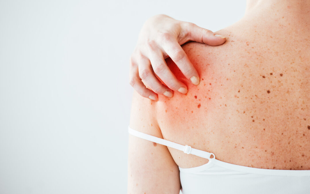 Understanding Excoriation Disorder: Symptoms, Causes, and Treatment